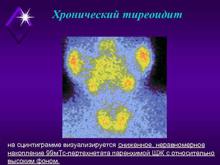 Хронический тиреоидит на сцинтиграмме визуализируется сниженное, неравномерное накопление 99 м. Тс-пертехнетата паренхимой ЩЖ с