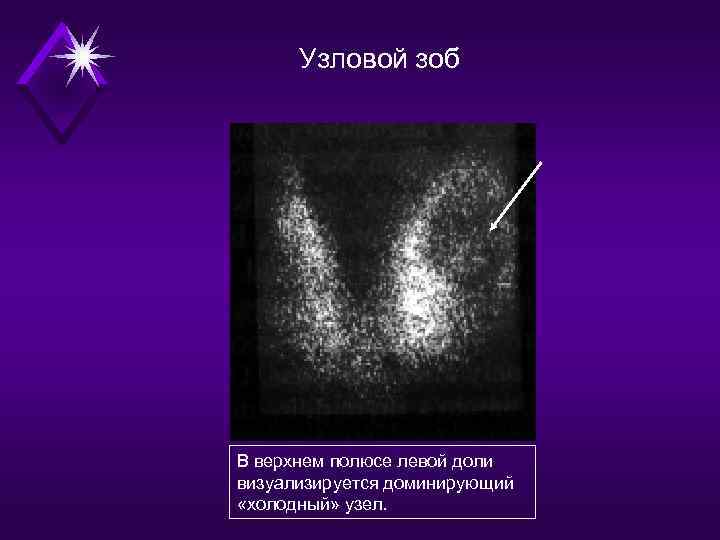 Узловой зоб В верхнем полюсе левой доли визуализируется доминирующий «холодный» узел. 