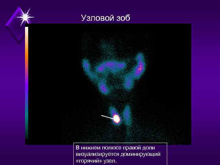 Узловой зоб В нижнем полюсе правой доли визуализируется доминирующий «горячий» узел. 