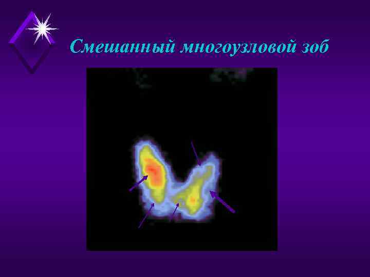 Смешанный многоузловой зоб 