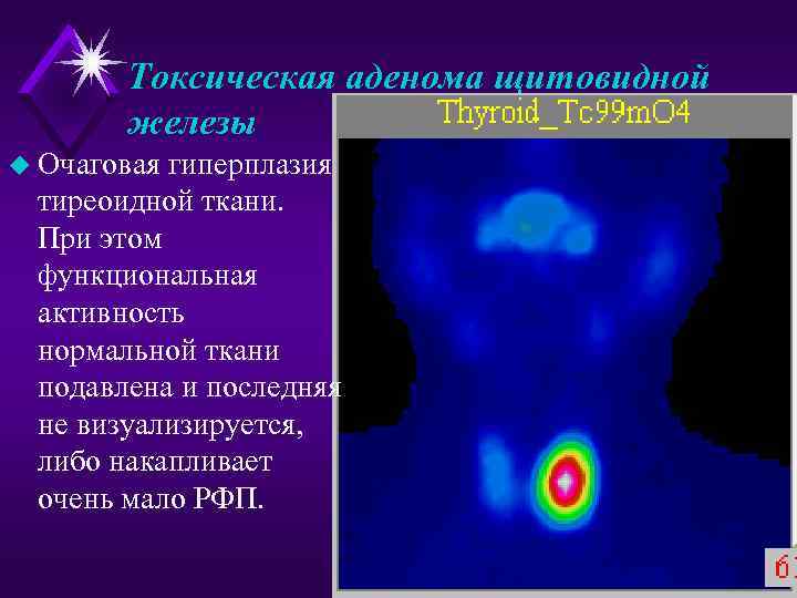Токсическая аденома щитовидной железы u Очаговая гиперплазия тиреоидной ткани. При этом функциональная активность нормальной