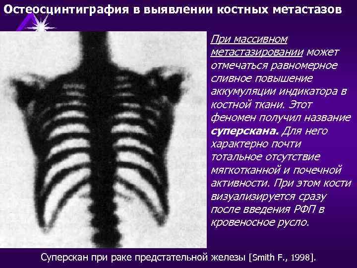 Остеосцинтиграфия в выявлении костных метастазов При массивном метастазировании может отмечаться равномерное сливное повышение аккумуляции