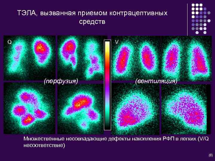 ТЭЛА, вызванная приемом контрацептивных средств Q V (перфузия) (вентиляция) Множественные несовпадающие дефекты накопления РФП