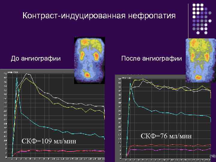 Контраст-индуцированная нефропатия До ангиографии СКФ=109 мл/мин После ангиографии СКФ=76 мл/мин (16) 