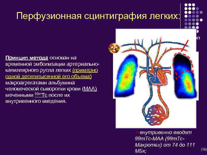 Перфузионная сцинтиграфия легких: Эмбол Принцип метода основан на временной эмболизации артериальнокапиллярного русла легких (примерно