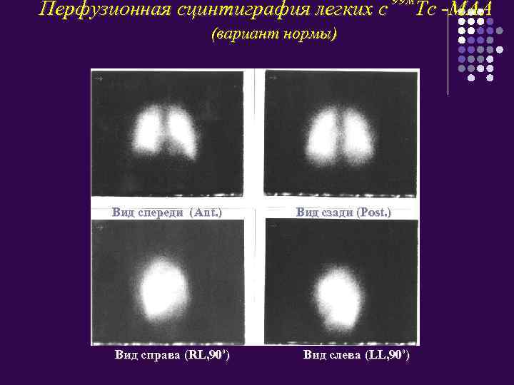 Перфузионная сцинтиграфия легких с 99 м (вариант нормы) Вид спереди (Ant. ) Вид справа