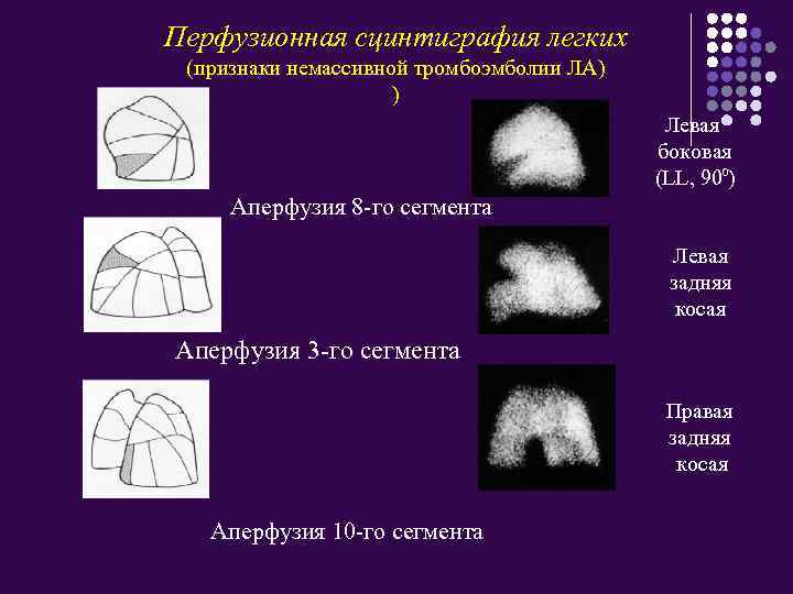 Перфузионная сцинтиграфия легких (признаки немассивной тромбоэмболии ЛА) ) Левая боковая (LL, 900) Аперфузия 8