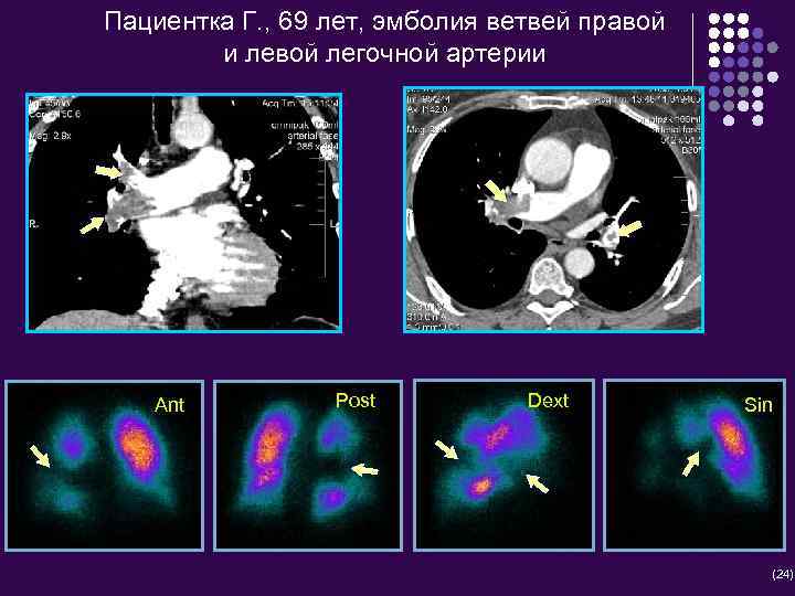 Пациентка Г. , 69 лет, эмболия ветвей правой и левой легочной артерии Ant Post