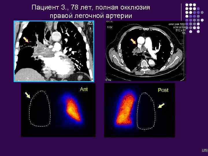 Пациент З. , 78 лет, полная окклюзия правой легочной артерии Ant Post (25) 