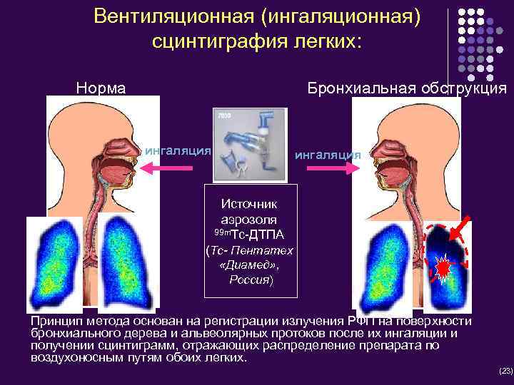 Легкое проведение. Ингаляционная сцинтиграфия легких. Вентиляционная сцинтиграфия. Вентиляционная сцинтиграфия легких норма. Вентиляционная сцинтиграфия легких радиофармпрепараты.