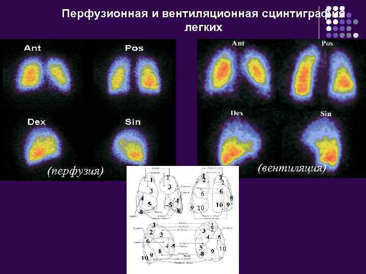 Перфузионная и вентиляционная сцинтиграфия легких (перфузия) (вентиляция) 
