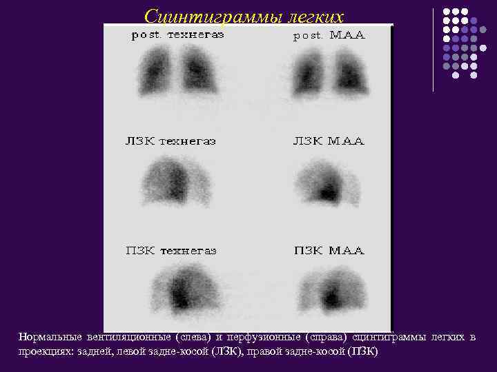 Сцинтиграммы легких Нормальные вентиляционные (слева) и перфузионные (справа) сцинтиграммы легких в проекциях: задней, левой