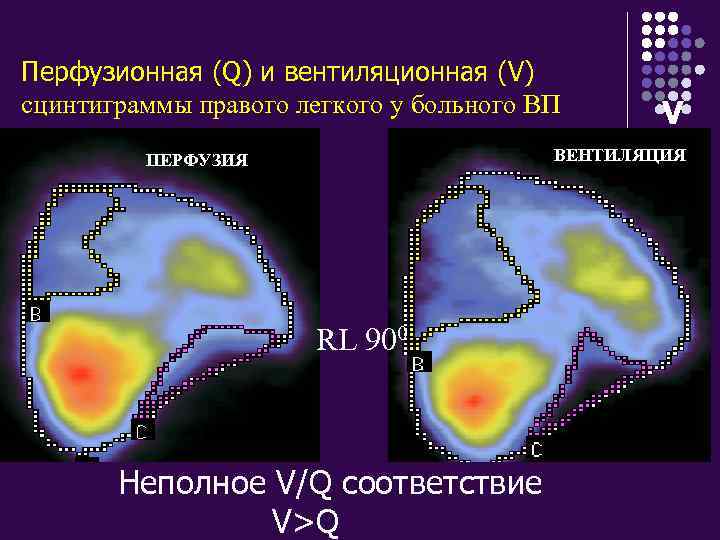 Перфузионная (Q) и вентиляционная (V) сцинтиграммы правого легкого у больного ВП V ВЕНТИЛЯЦИЯ ПЕРФУЗИЯ