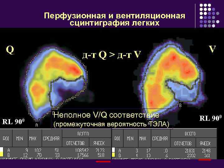 Перфузионная и вентиляционная сцинтиграфия легких Q RL д-т Q > д-т V 900 Неполное