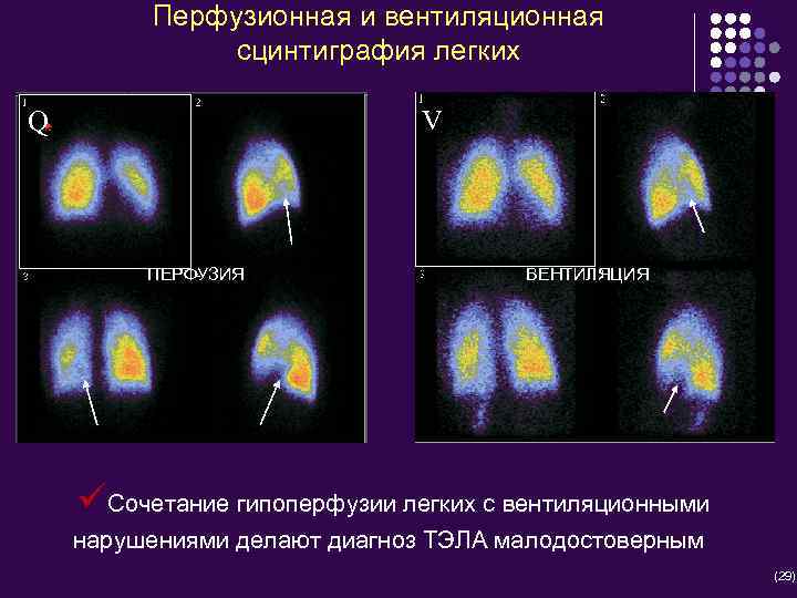 Перфузионная и вентиляционная сцинтиграфия легких V Q ПЕРФУЗИЯ ВЕНТИЛЯЦИЯ üСочетание гипоперфузии легких с вентиляционными