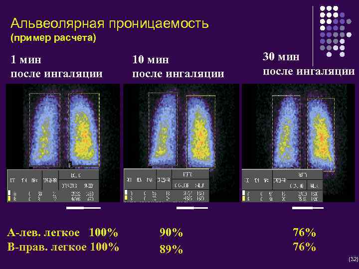 Альвеолярная проницаемость (пример расчета) 1 мин после ингаляции А-лев. легкое 100% В-прав. легкое 100%