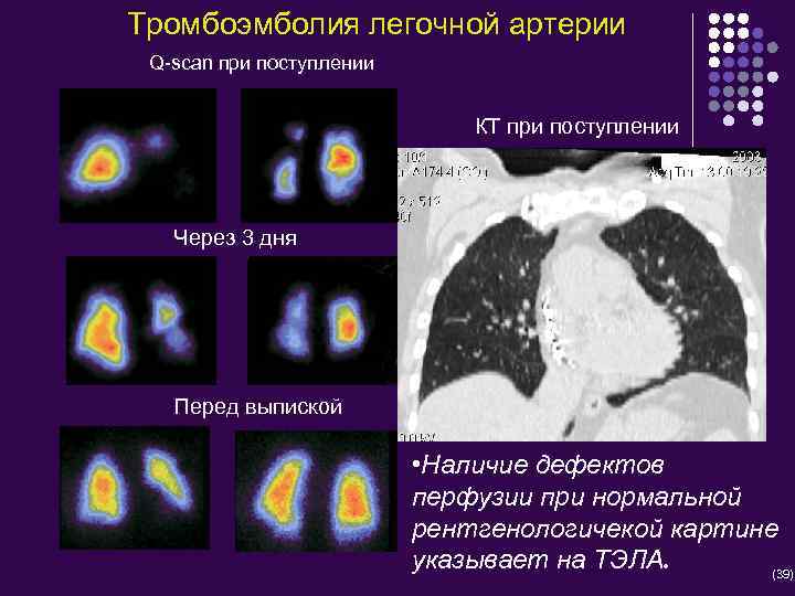 Тромбоэмболия легочной артерии Q-scan при поступлении КТ при поступлении Через 3 дня Перед выпиской