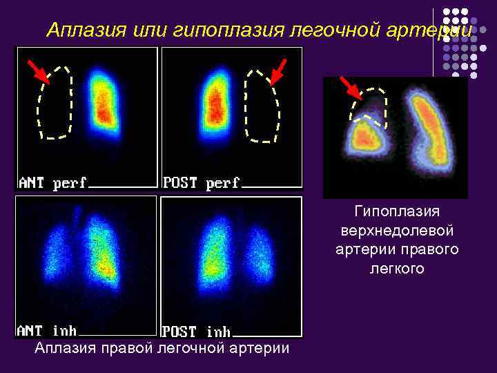 Аплазия или гипоплазия легочной артерии Гипоплазия верхнедолевой артерии правого легкого Аплазия правой легочной артерии