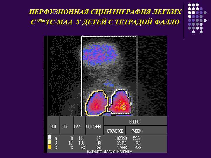 ПЕРФУЗИОННАЯ СЦИНТИГРАФИЯ ЛЕГКИХ С 99 m. ТС-МАА У ДЕТЕЙ С ТЕТРАДОЙ ФАЛЛО 
