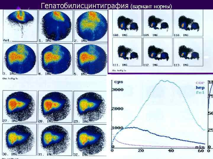 Гепатобилисцинтиграфия (вариант нормы) 