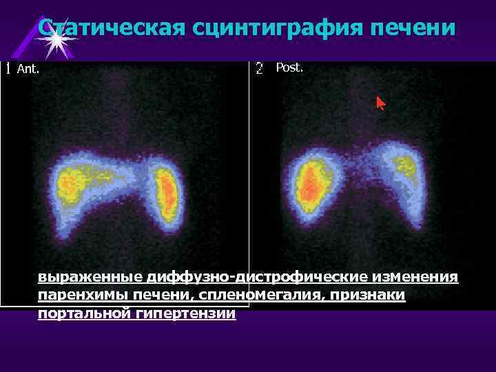 Статическая сцинтиграфия печени Ant. Post. выраженные диффузно-дистрофические изменения паренхимы печени, спленомегалия, признаки портальной гипертензии
