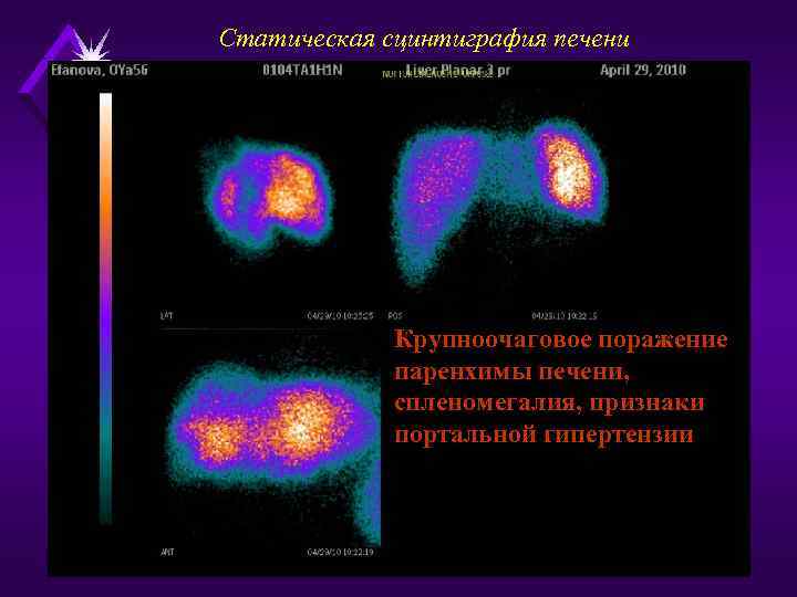 Статическая сцинтиграфия печени Крупноочаговое поражение паренхимы печени, спленомегалия, признаки портальной гипертензии 