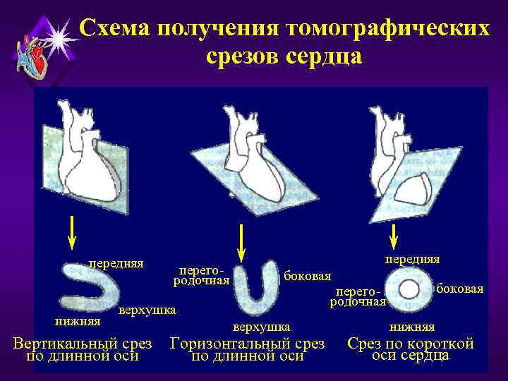 Схема получения томографических срезов сердца передняя нижняя перегородочная передняя боковая верхушка Вертикальный срез по