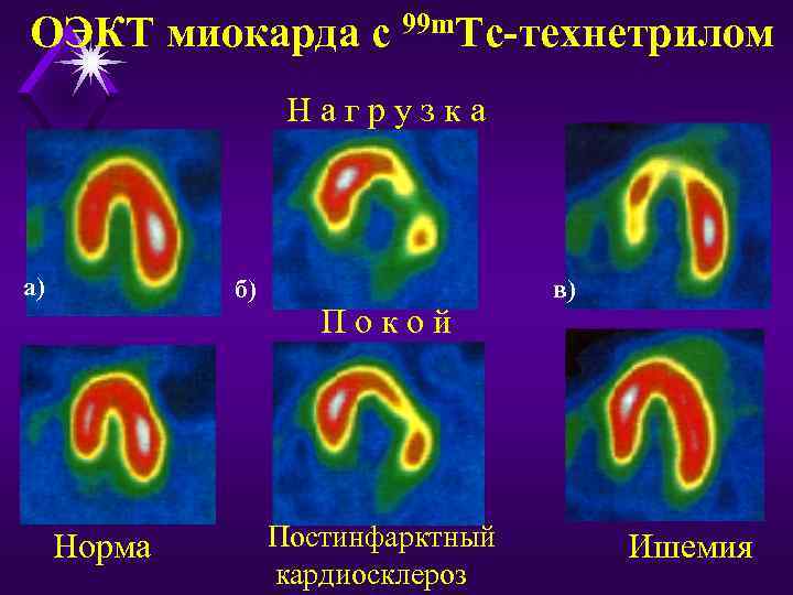 ОЭКТ миокарда с 99 m. Тс-технетрилом Н а г р у з к а