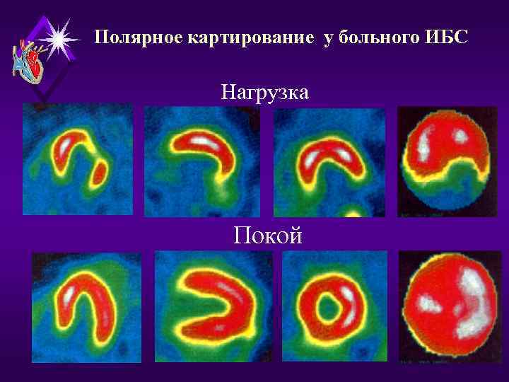 Полярное картирование у больного ИБС Нагрузка Покой 