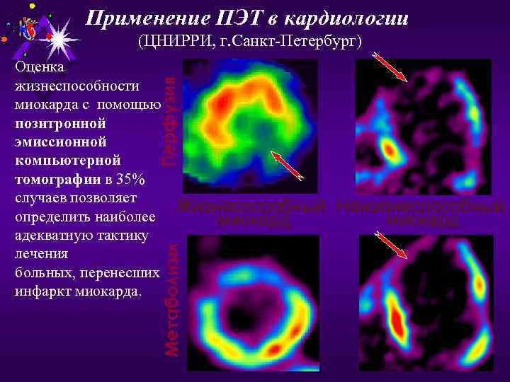 Применение ПЭТ в кардиологии (ЦНИРРИ, г. Санкт-Петербург) Метаболизм Перфузия Оценка жизнеспособности миокарда с помощью