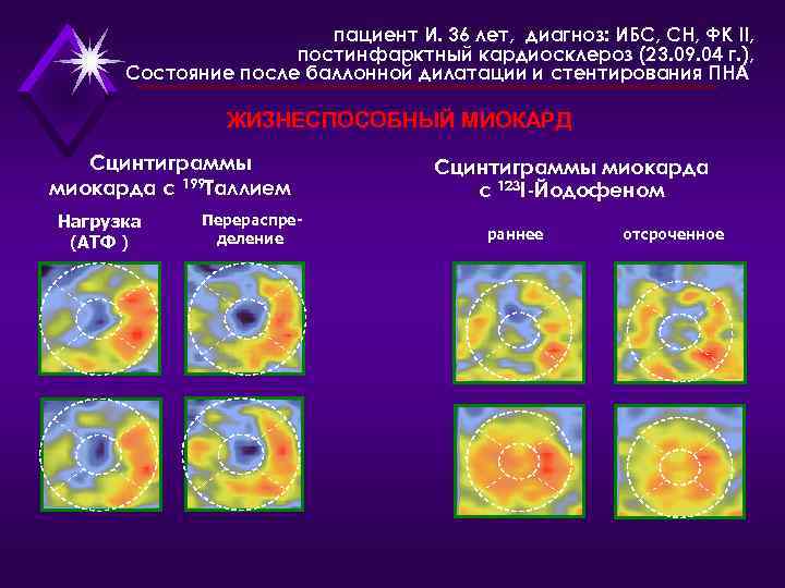 пациент И. 36 лет, диагноз: ИБС, СН, ФК II, постинфарктный кардиосклероз (23. 09. 04