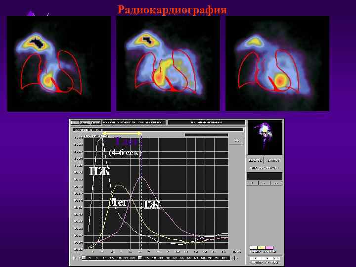 Радиокардиография Тлег. (4 -6 сек) ПЖ Лег ЛЖ 