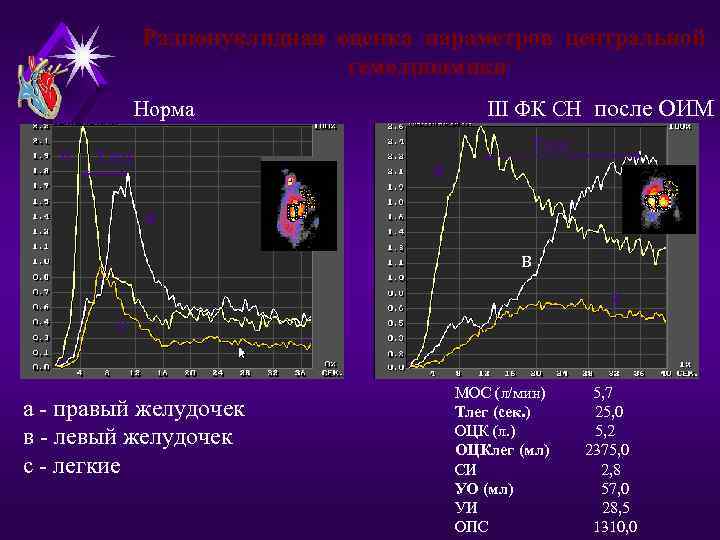 Радионуклидная оценка параметров центральной гемодинамики Норма III ФК СН после ОИМ а Тлег в