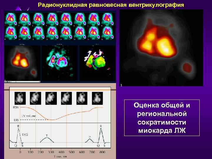 Радионуклидная равновесная вентрикулография Оценка общей и региональной сократимости миокарда ЛЖ 