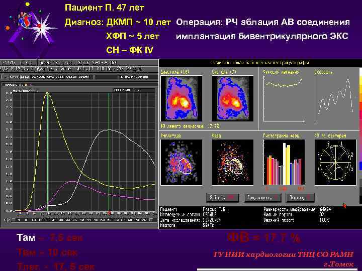 Пациент П. 47 лет Диагноз: ДКМП ~ 10 лет Операция: РЧ аблация АВ соединения