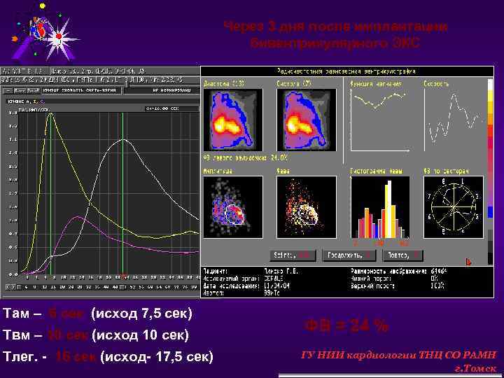 Через 3 дня после имплантации бивентрикулярного ЭКС Там – 6 сек (исход 7, 5