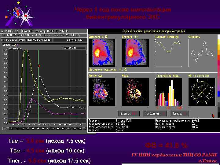 Через 1 год после имплантации бивентрикулярного ЭКС Там – 5, 0 сек (исход 7,