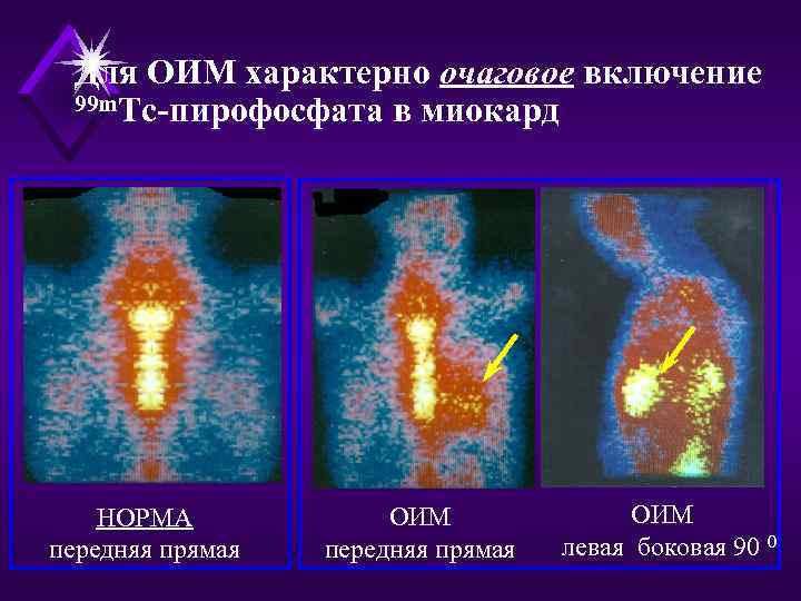 Для ОИМ характерно очаговое включение 99 m. Tc-пирофосфата в миокард НОРМА передняя прямая ОИМ