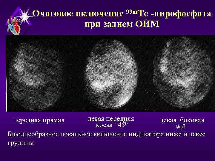 Очаговое включение 99 m. Tc -пирофосфата при заднем ОИМ левая передняя левая боковая 0