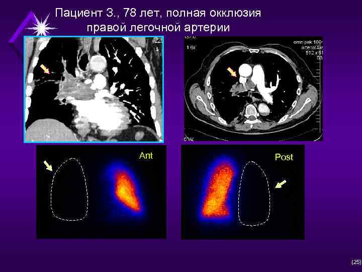 Пациент З. , 78 лет, полная окклюзия правой легочной артерии Ant Post (25) 