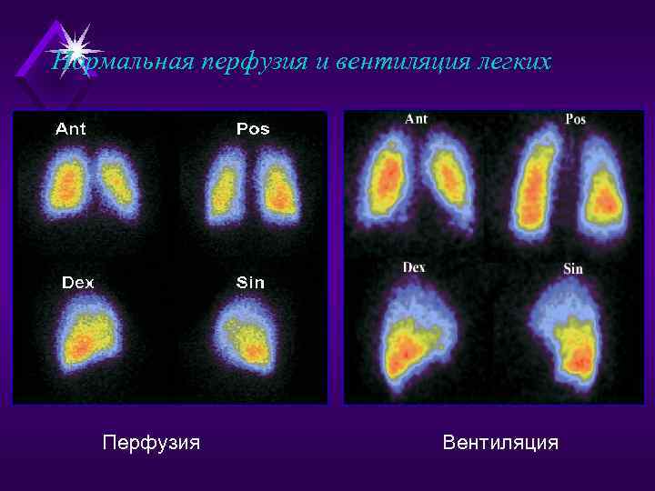 Нормальная перфузия и вентиляция легких Перфузия Вентиляция 