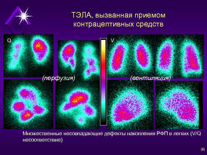 ТЭЛА, вызванная приемом контрацептивных средств Q V (перфузия) (вентиляция) Множественные несовпадающие дефекты накопления РФП