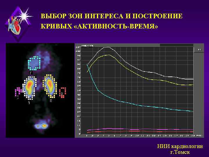 ВЫБОР ЗОН ИНТЕРЕСА И ПОСТРОЕНИЕ КРИВЫХ «АКТИВНОСТЬ-ВРЕМЯ» НИИ кардиологии г. Томск 