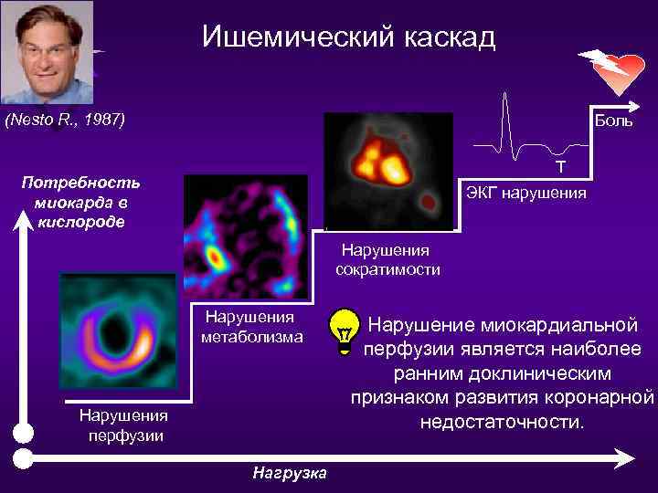 Ишемический каскад (Nesto R. , 1987) Боль T Потребность миокарда в кислороде ЭКГ нарушения