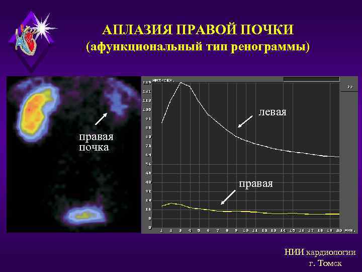 АПЛАЗИЯ ПРАВОЙ ПОЧКИ (афункциональный тип ренограммы) левая правая почка правая НИИ кардиологии г. Томск