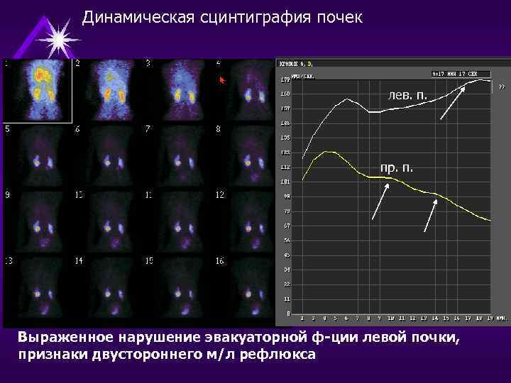 Динамическая сцинтиграфия почек лев. п. пр. п. Выраженное нарушение эвакуаторной ф-ции левой почки, признаки