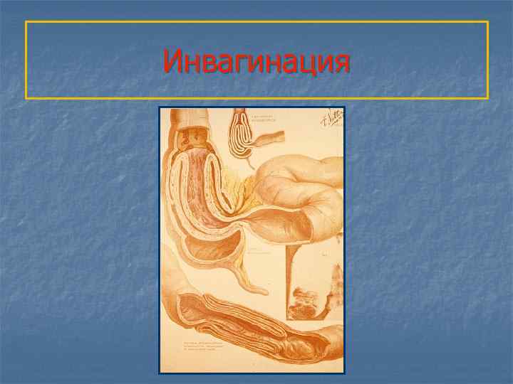 Инвагинация 