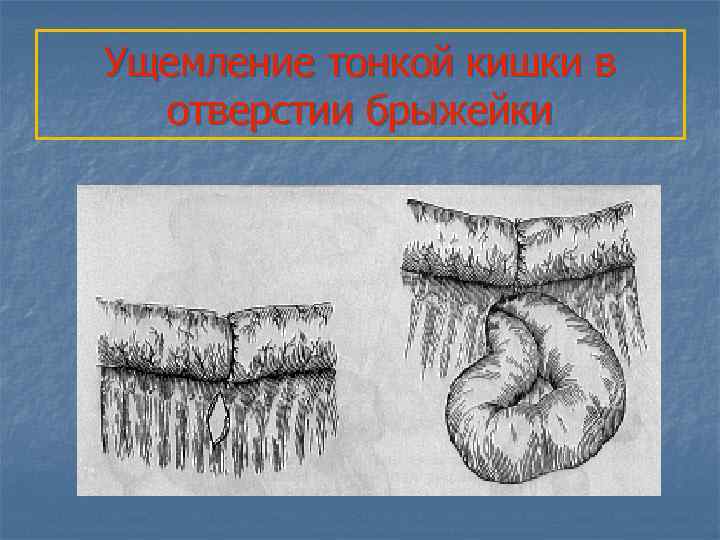 Ущемление тонкой кишки в отверстии брыжейки 
