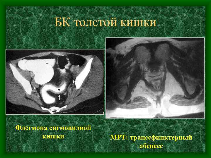 БК толстой кишки Флегмона сигмовидной кишки МРТ: транссфинктерный абсцесс 