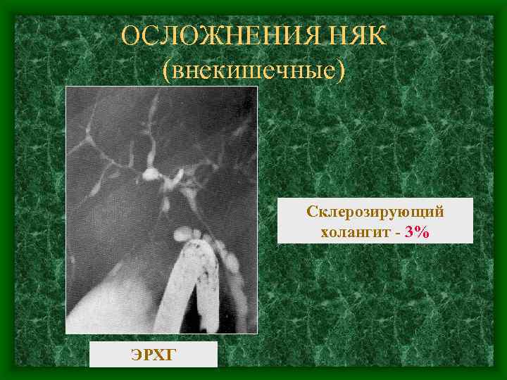 ОСЛОЖНЕНИЯ НЯК (внекишечные) Склерозирующий холангит - 3% ЭРХГ 